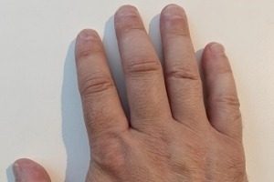 Resultat efter hypnosebehandling mod neglebidning