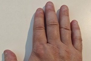 Neglebidning før hypnosebehandling