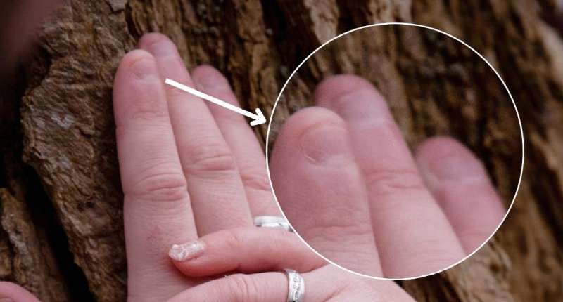 Hypnose for at undgå grimme negle på bryllupsbilleder Undgå grimme negle på bryllupsbilleder med hypnose mod neglebidning